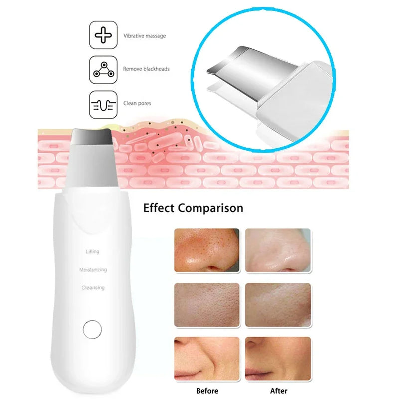 Esfoliador Facial Profissional™ com Tecnologia Iônica Removedor de Cravos